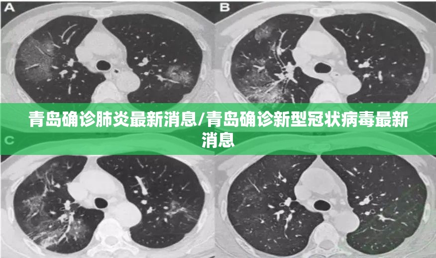 青岛确诊肺炎最新消息/青岛确诊新型冠状病毒最新消息